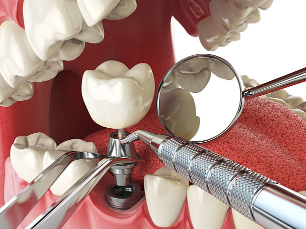 Best Urgent Care for Lost Fillings or Crowns in Havre, MT