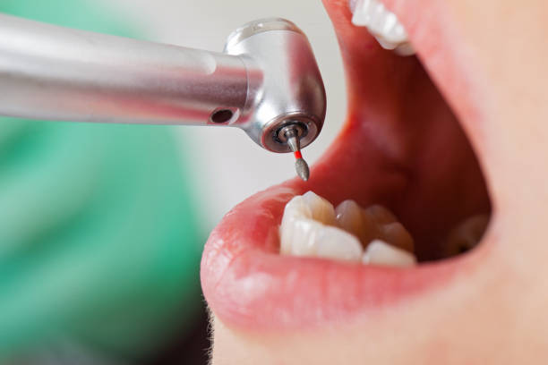 Best Emergency Dental Care for Broken or Chipped Teeth in Havre, MT